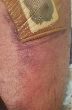 Hip surgery plaster 1