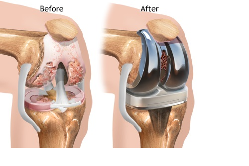 Knee Replacement