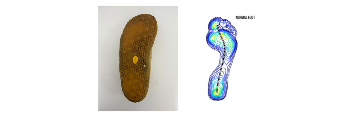 Foot Alignment, Loading and Plantar Fasciitis - Energy Medicine