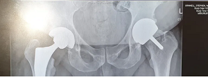 X Ray Hips