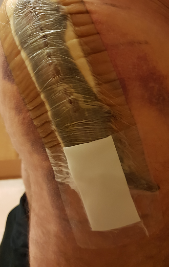 hip surgery plaster 2